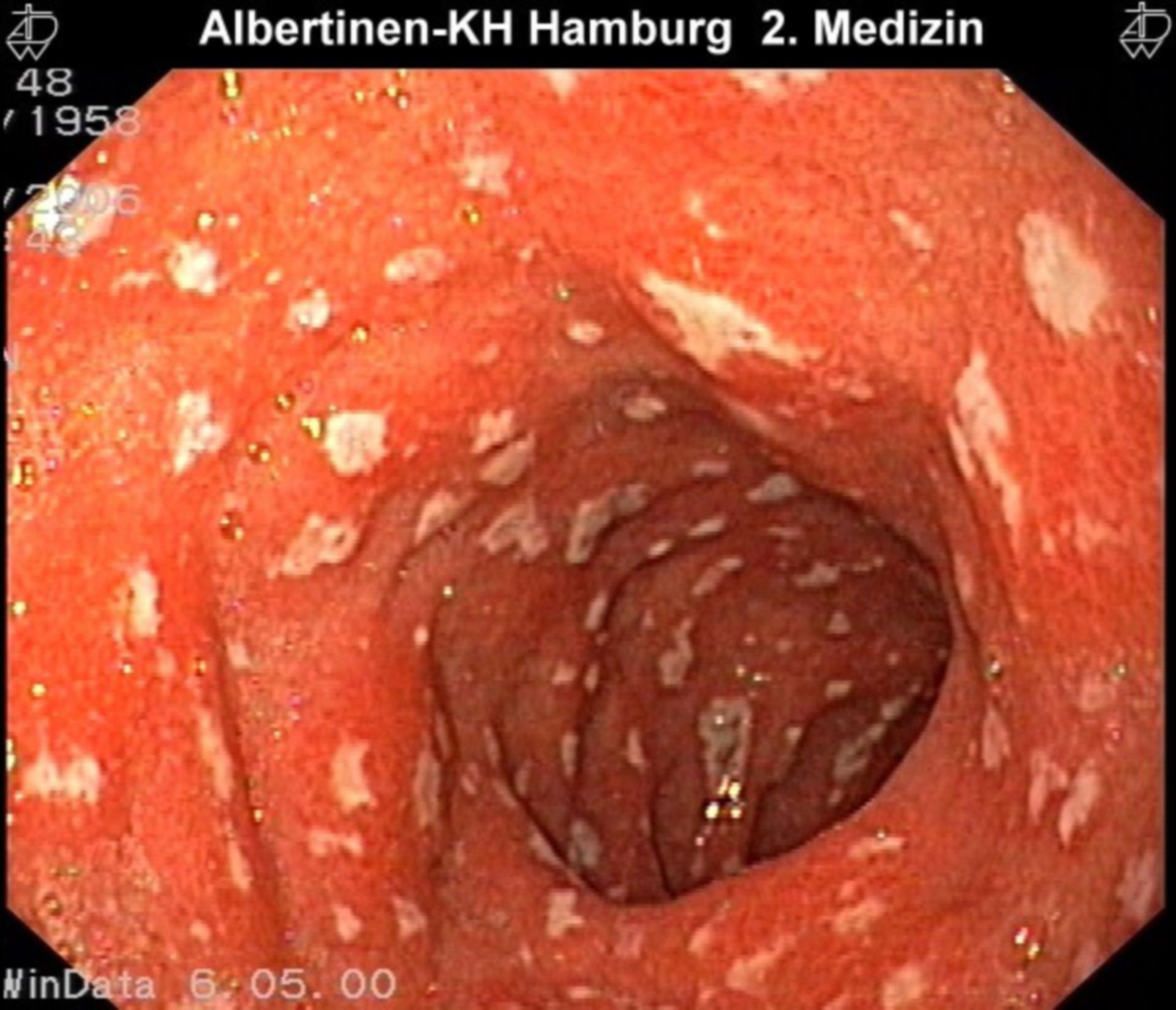 Multiple-Ulc-Duodenum