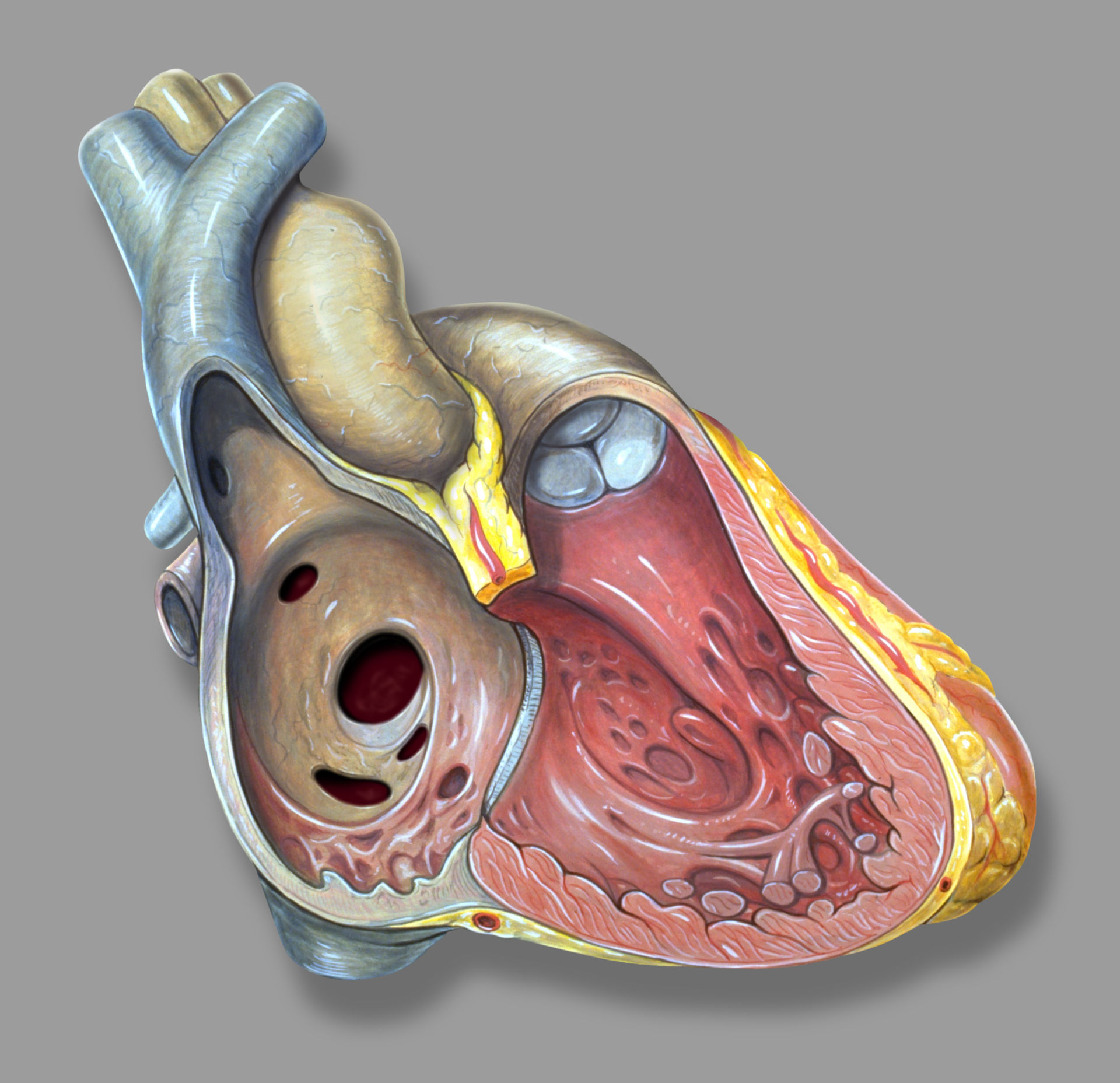 Eröffnetes Herz mit Vorhofseptumdefekten (Illustration)