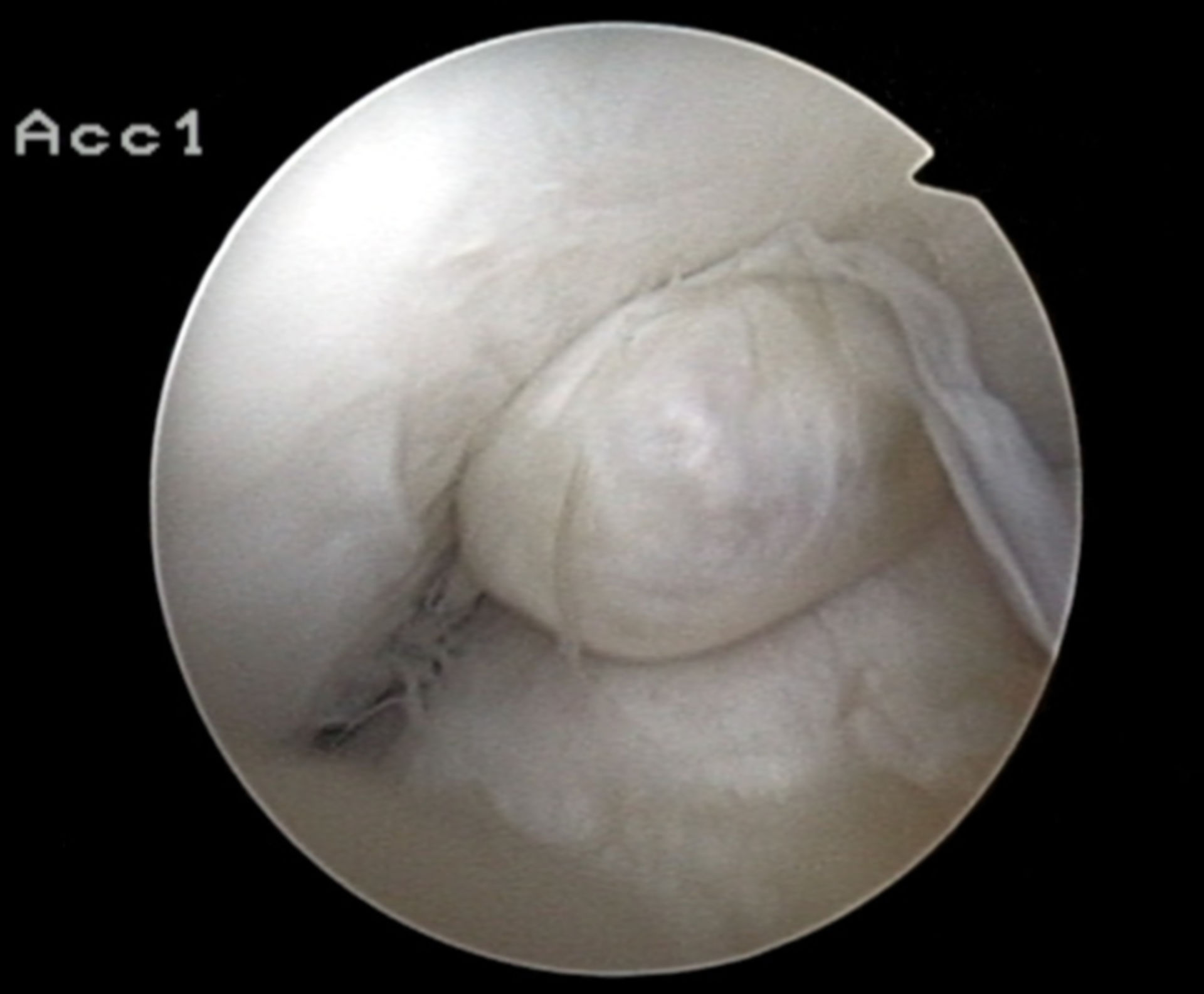 Arthroskopische Aufnahme eines Zyklops im Knie eines Patienten.