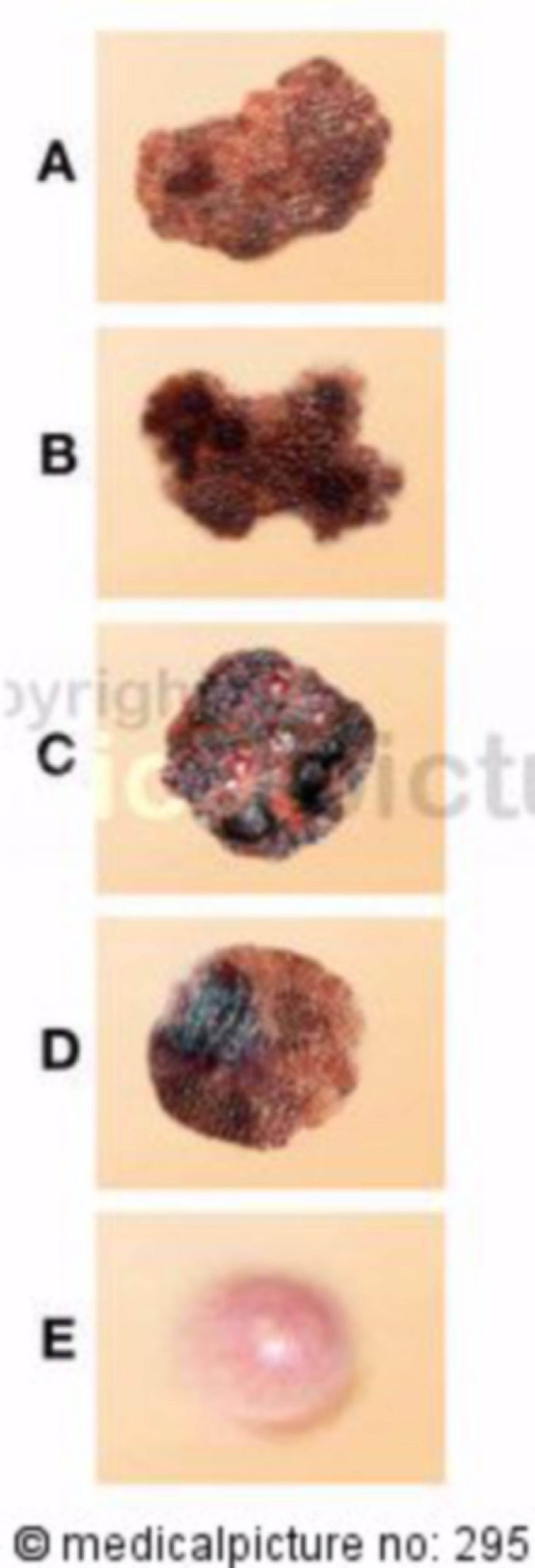 ABCDE-rule for differentiating skin tumors