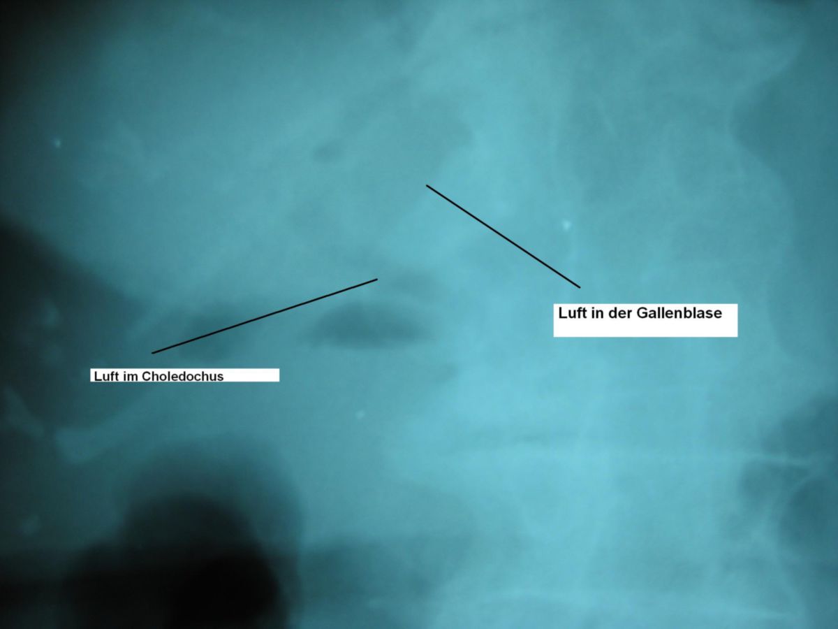 Gallensteinileus - Röntgenbild