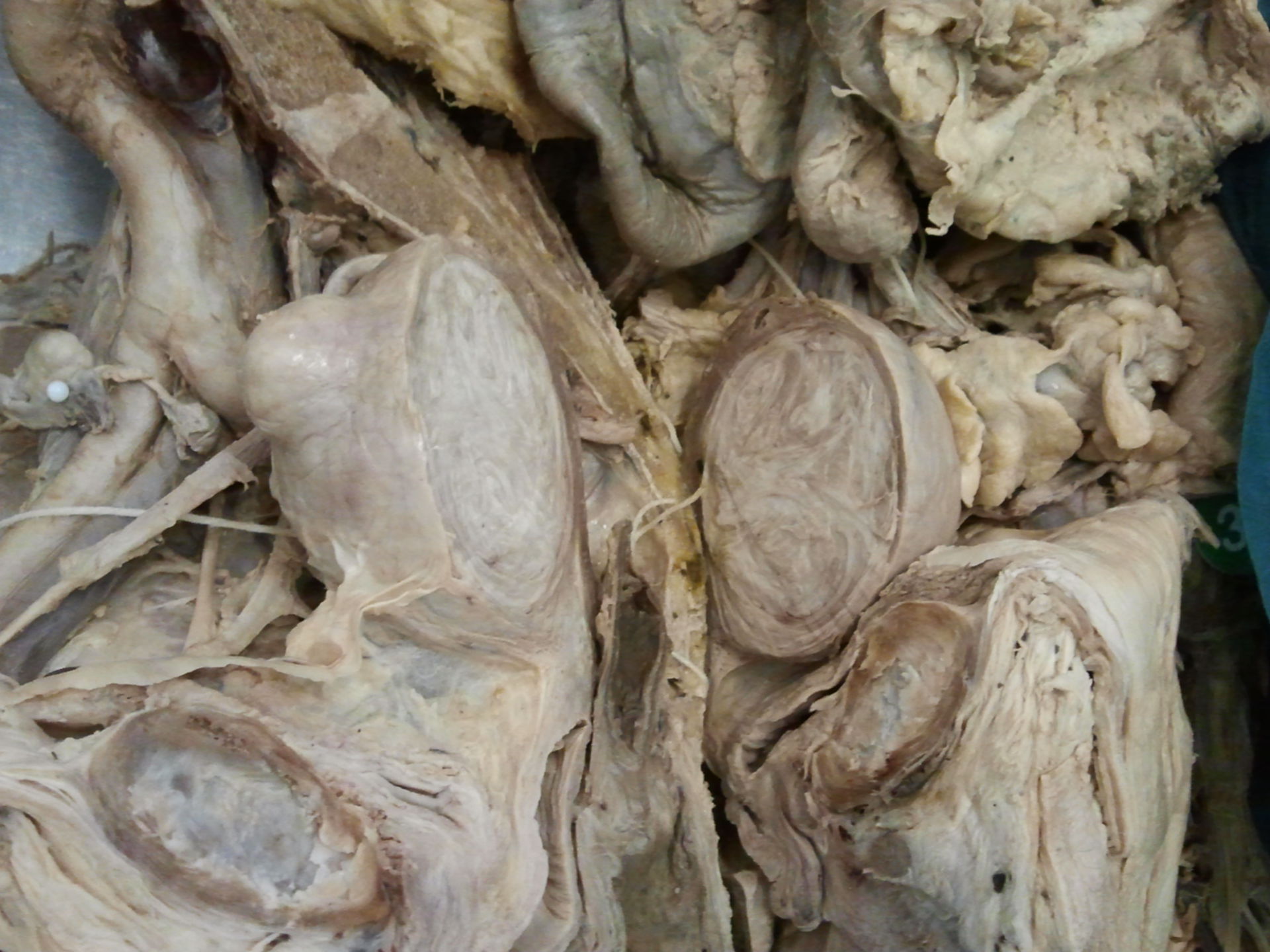 Uterine cyst open 2