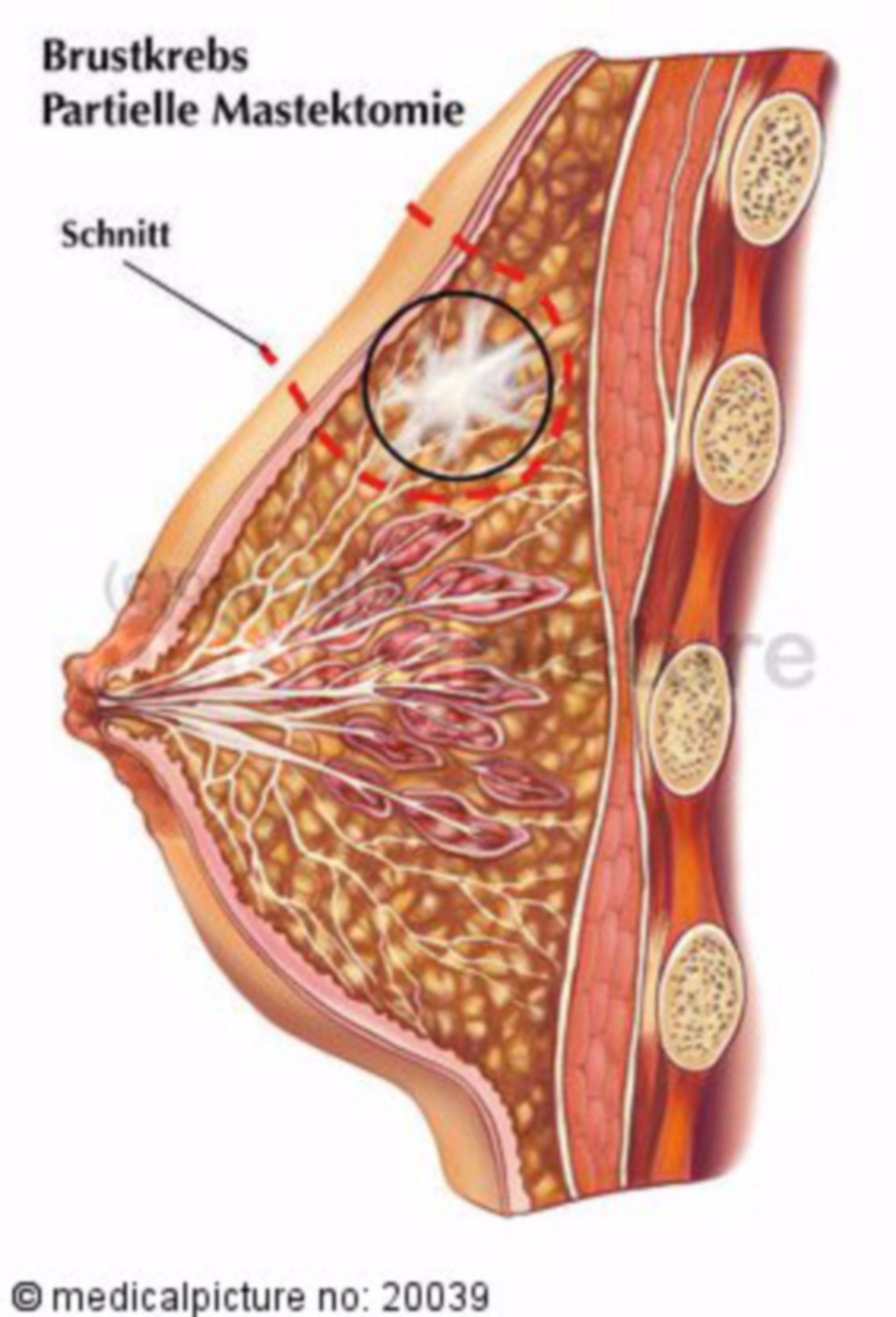 Partial Mastectomy in Mammary Carcinoma