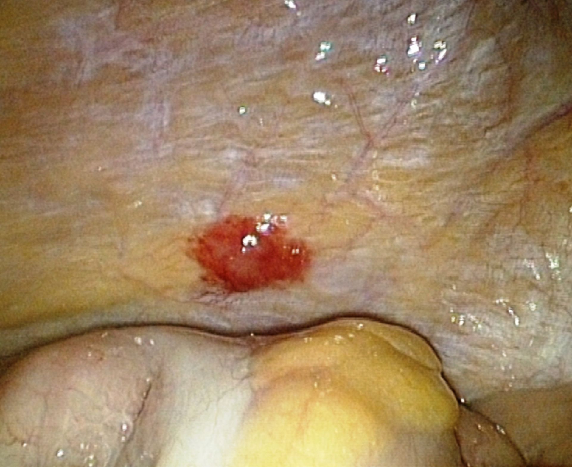 Peritoneale Metastase eines Prostata Ca.