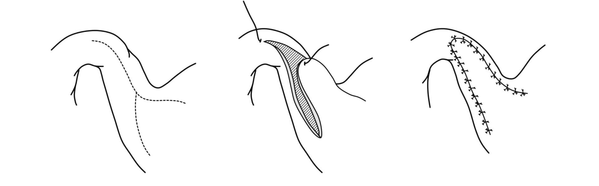 Y-U-Pyloroplastik