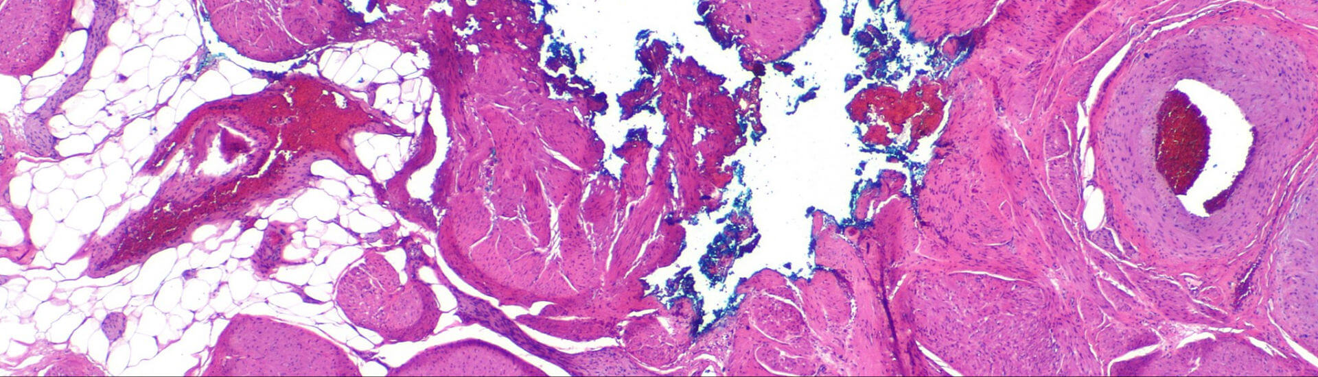 Prostata-Ca: Hat die Fusionsbiopsie Vorteile? - DocCheck