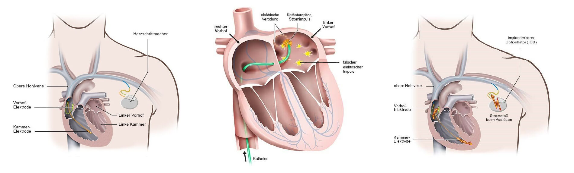 pm-ablation-icd-headerbild_original.jpg