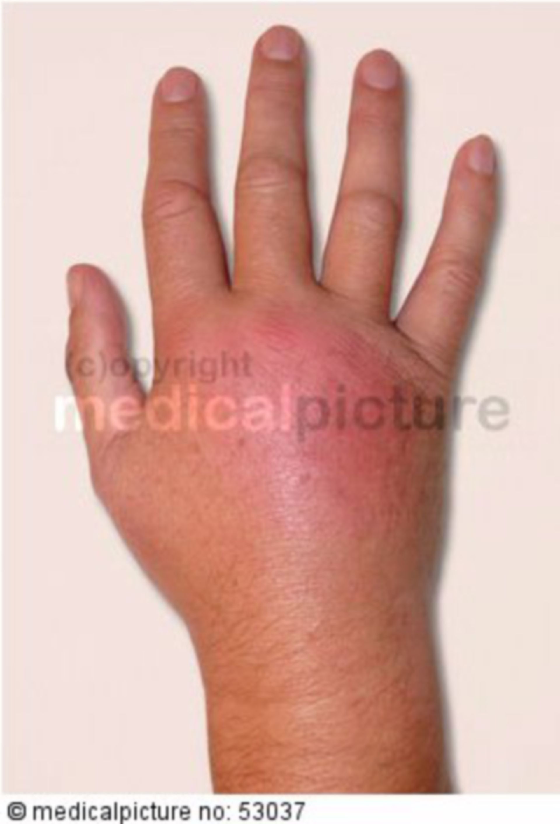 Hand after wasp sting