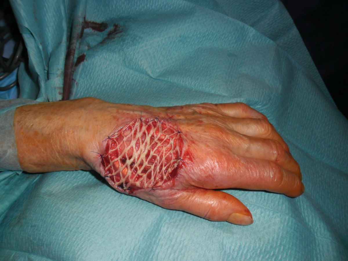 Hand nach Entfernung des Tumors und Bedecken mit Spalthaut