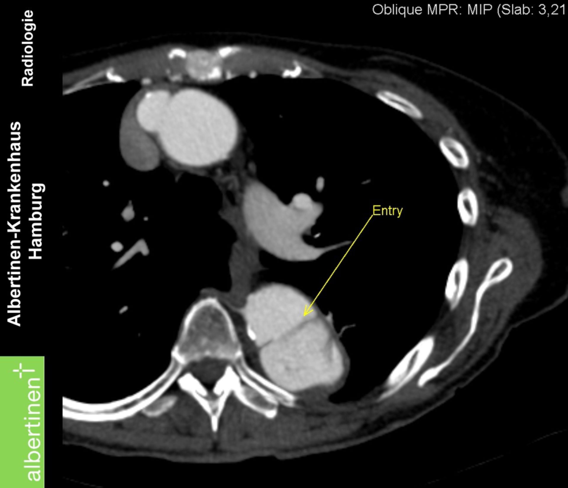 CT: Aortendissektion Entry Thorax