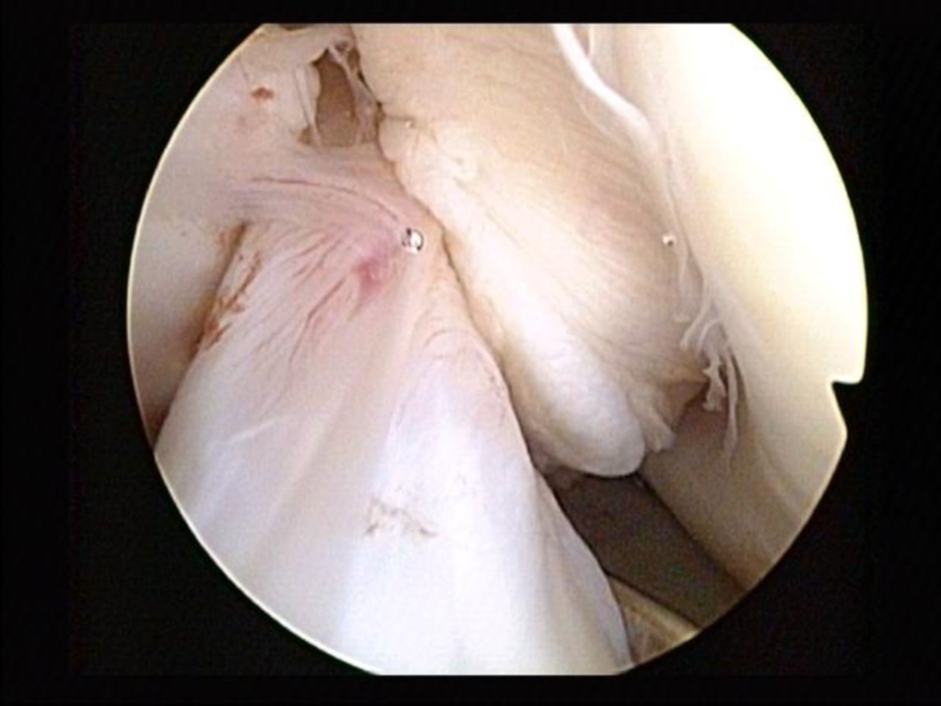Anterior cruciate ligament (arthroscopy)
