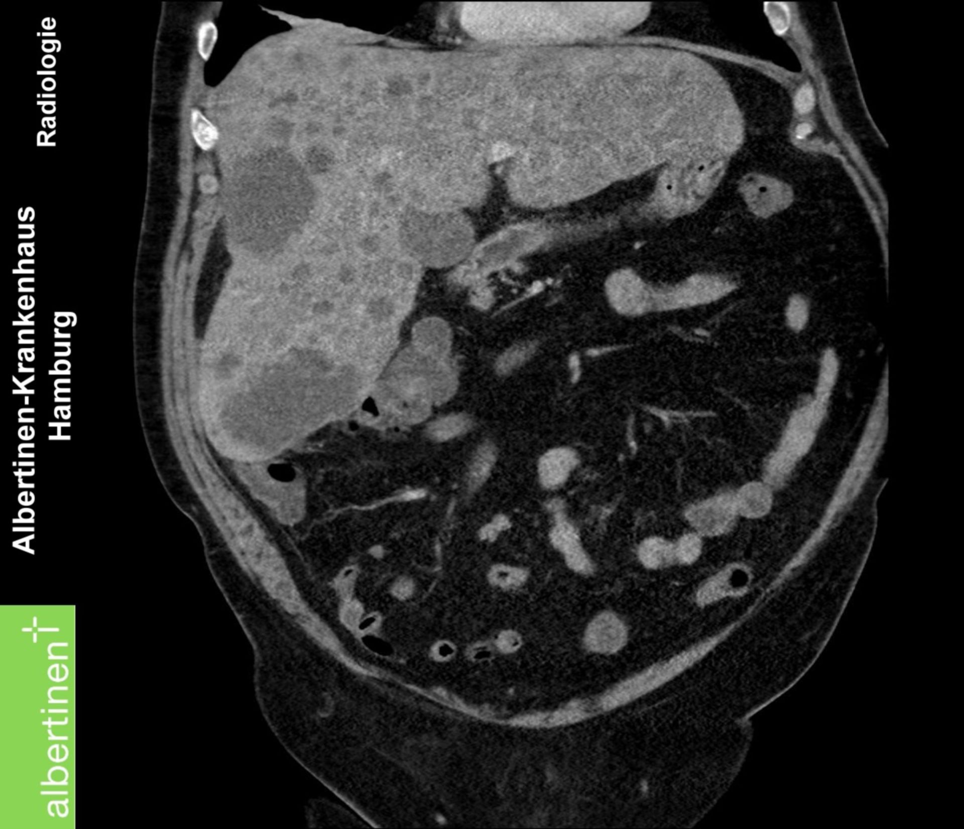 Lebermetastasen multipel CT coronar