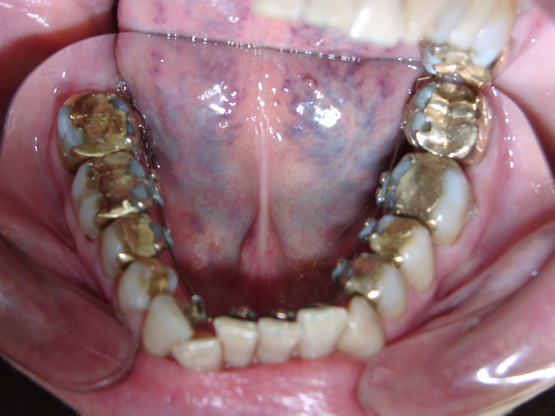 71-year-old female patient (maxilla) at the beginning of orthodontic treatment