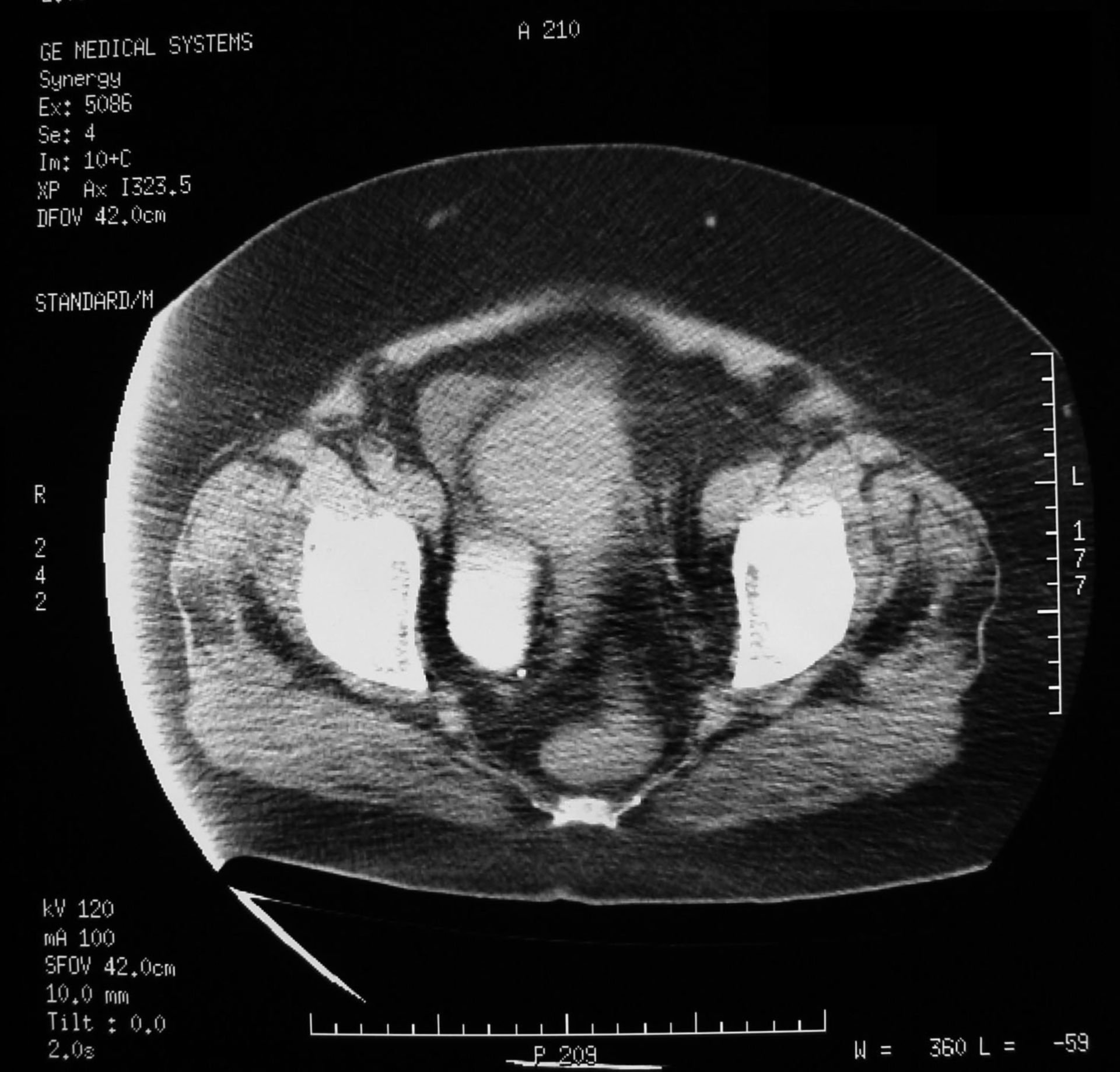 Uterus myomatosus (7)