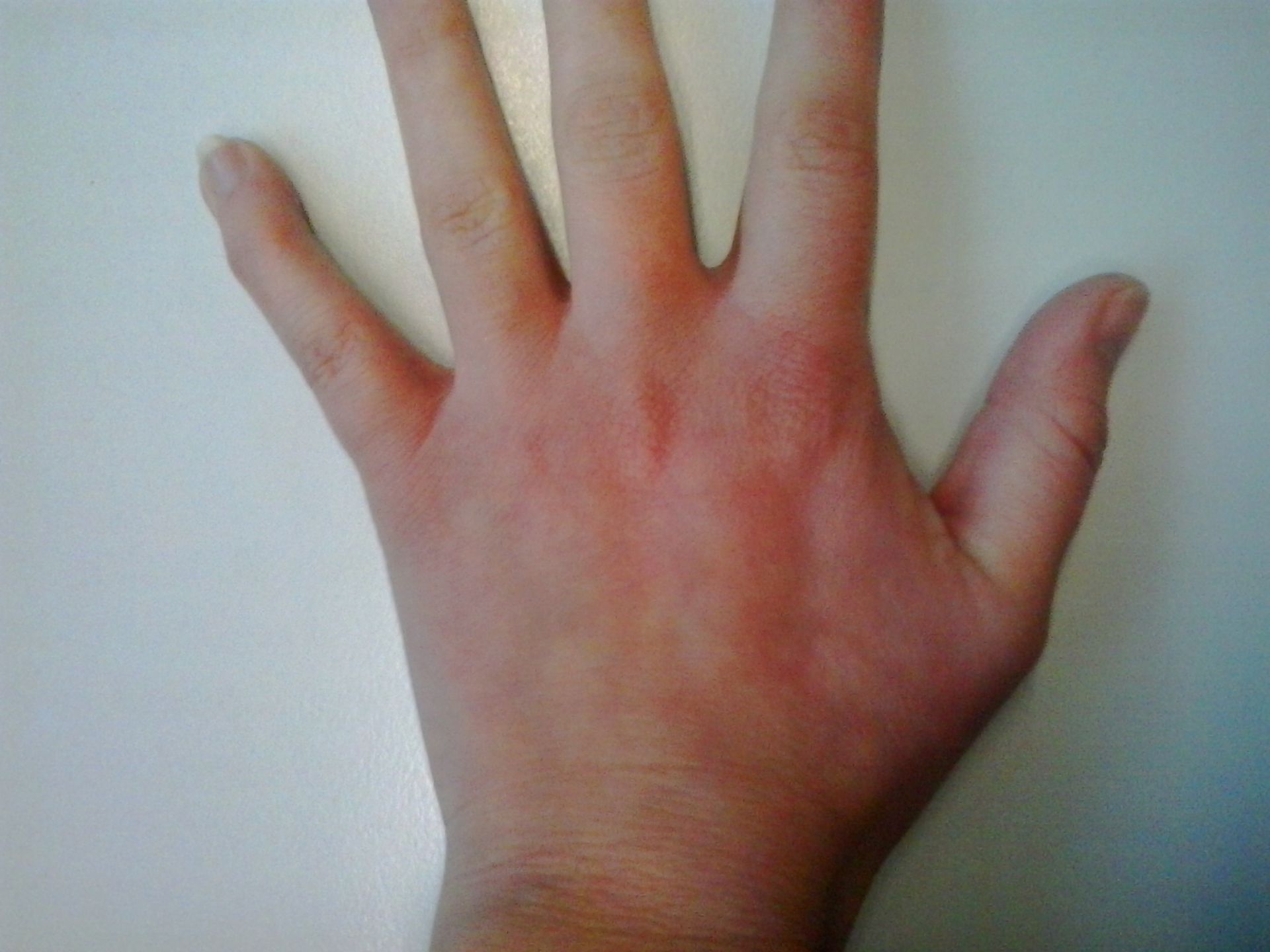Unbekannte Rötung beider Hände (1)