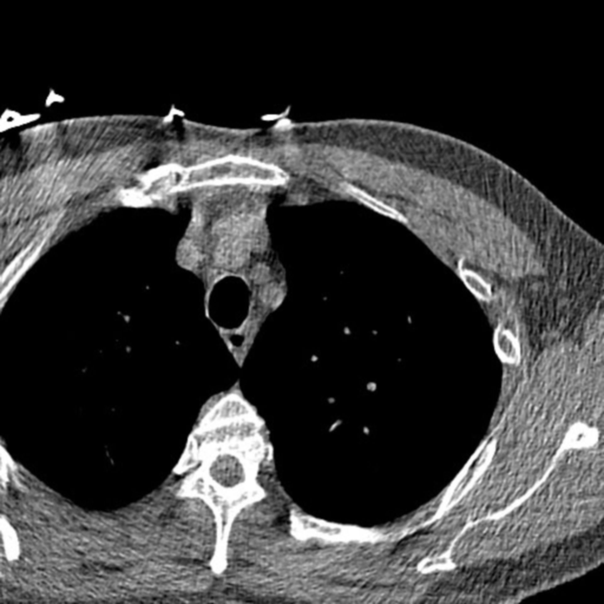 CT Thorax