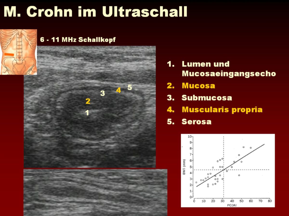 Morbus Crohn im Ultraschall