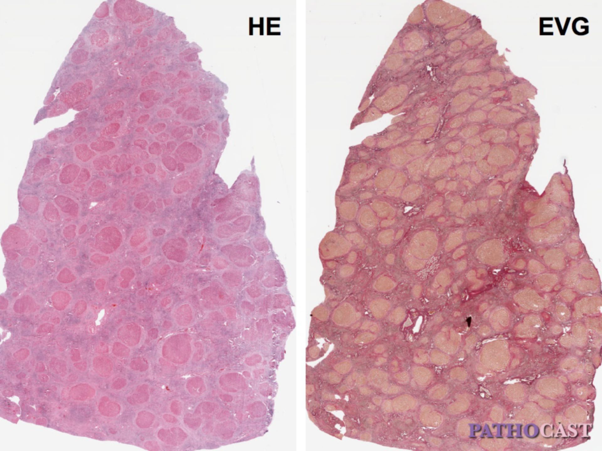 Liver cirrhosis