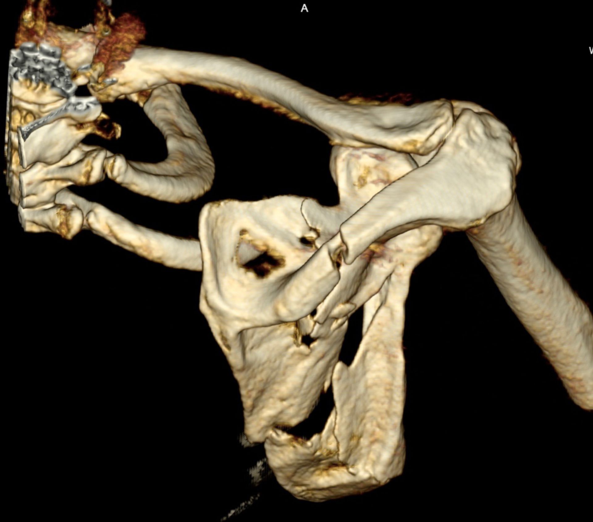 3D-Rekonstruktion einer CT des Schultergürtels mit Scapulatrümmerfraktur