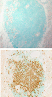 Die obere Abbildung zeigt einen blau eingefärbten Tumor vor der Bestrahlung. Die untere Abbildung zeigt, dass Bestrahlung eine starke Einwanderung von T-Killerzellen und Zerstörung des Tumors bewirkt © Wilhelm Sander-Stiftung