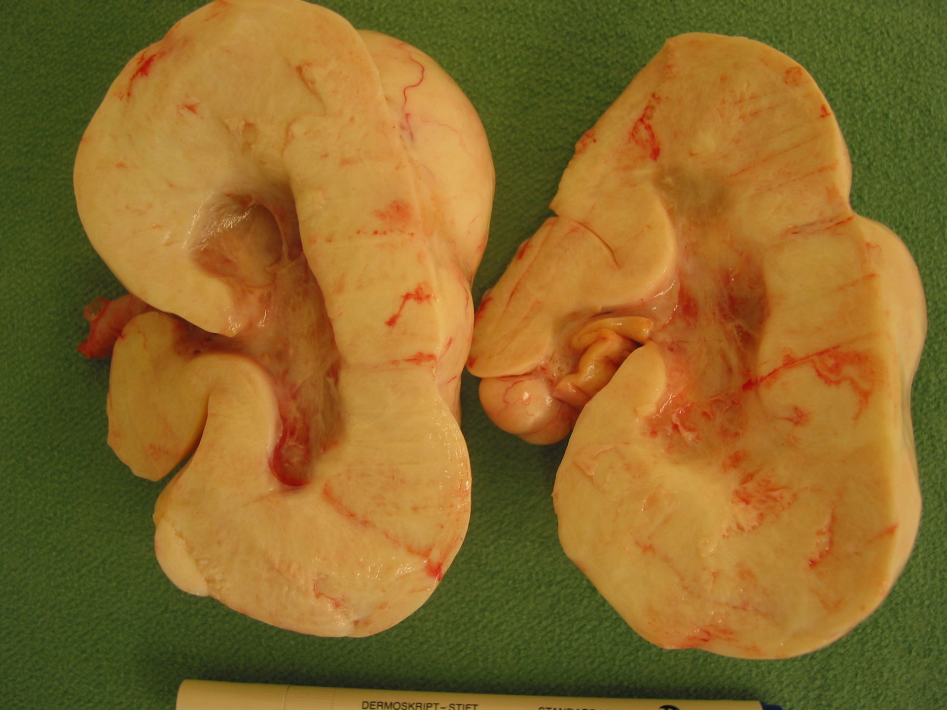 Theka-Granulosazelltumor des linken Ovars