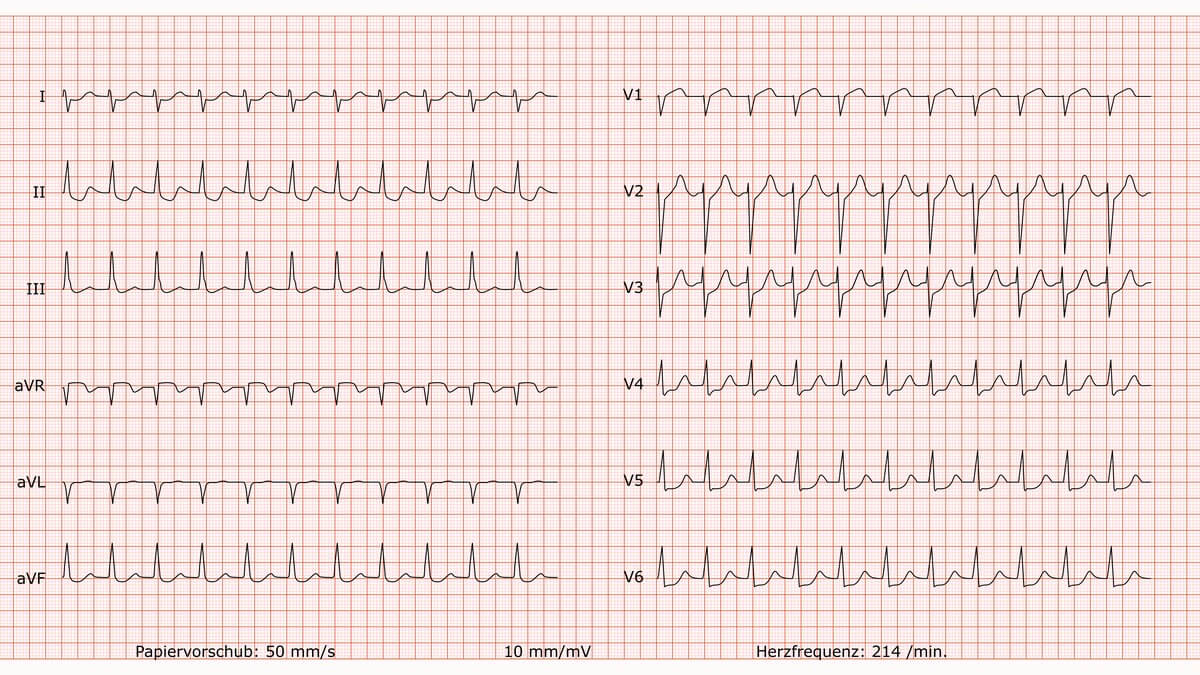 12-Kanal-EKG bei orthodromer AV-Reentrytachykardie