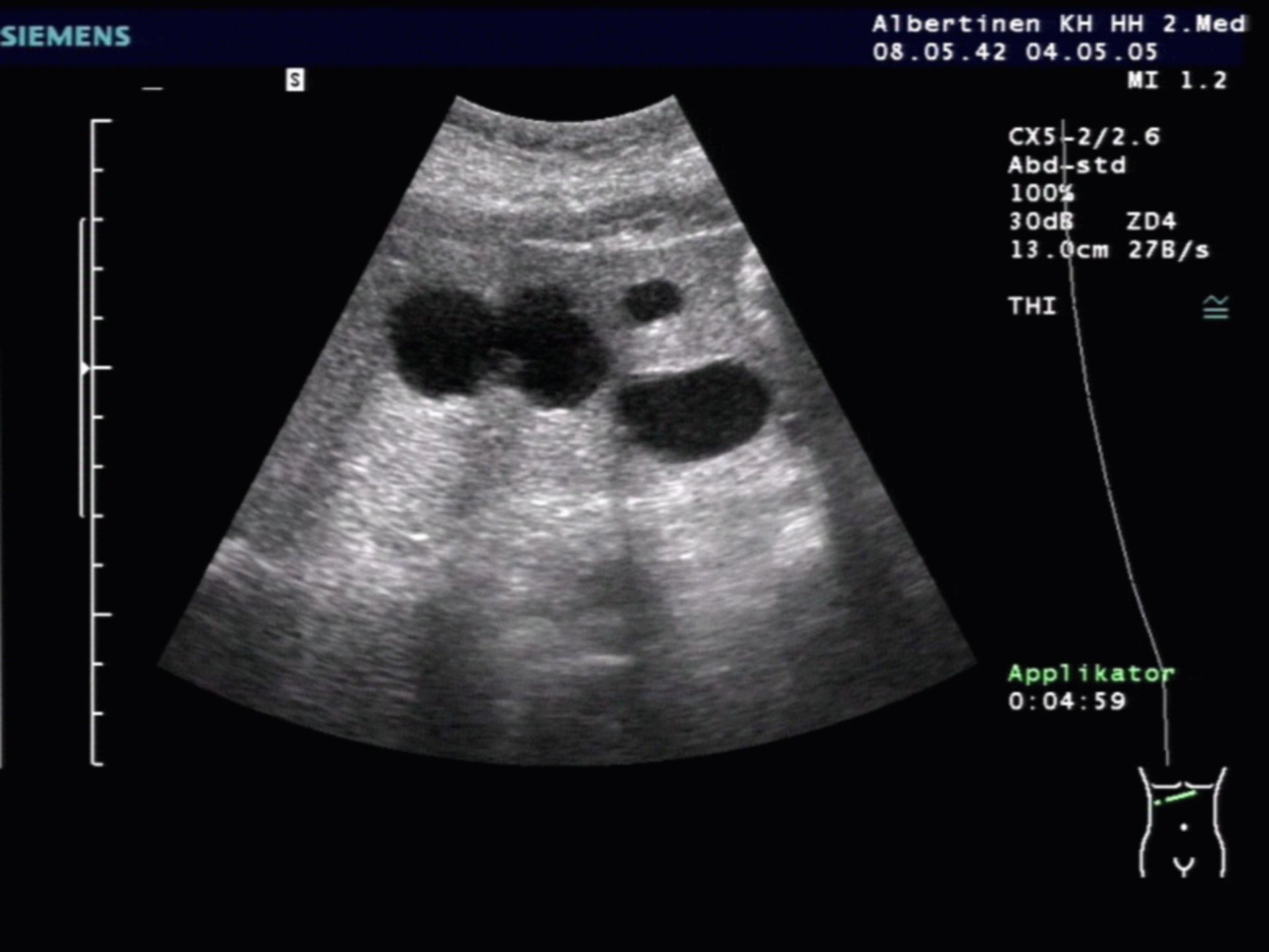 Liver cysts