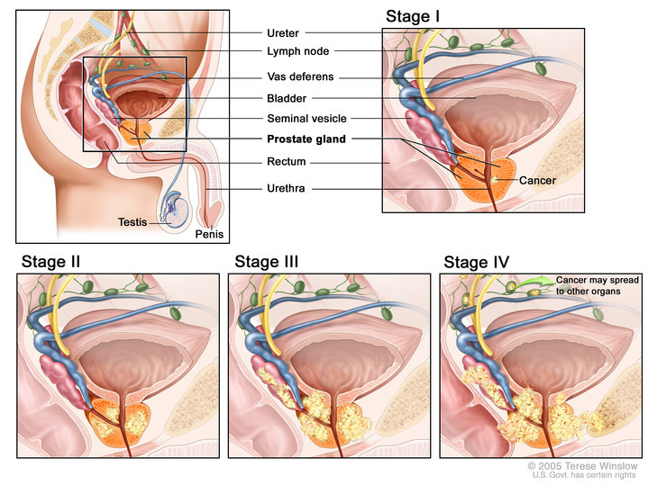 Stages of prostate cancer