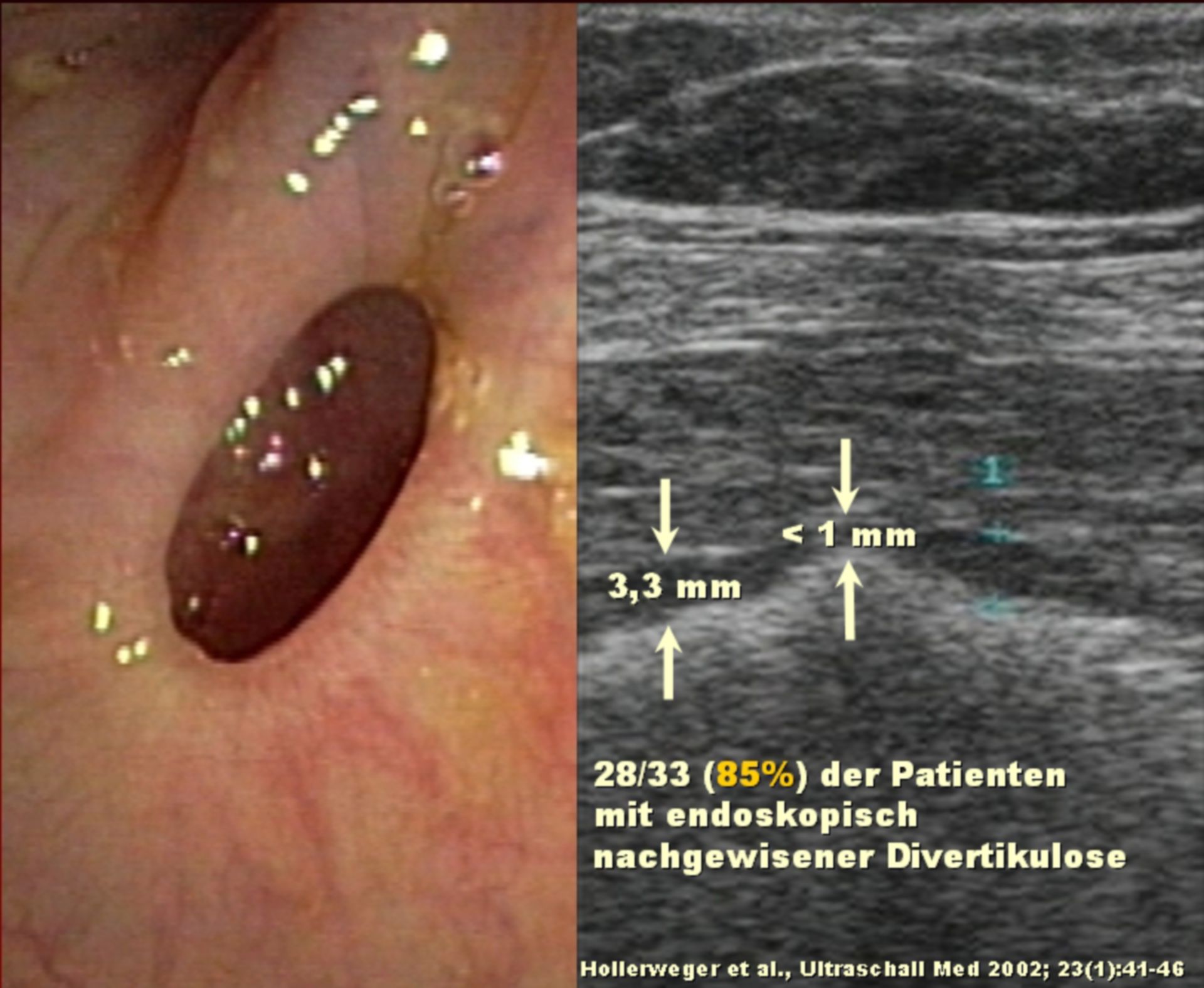 Diverticulum in the Sigma