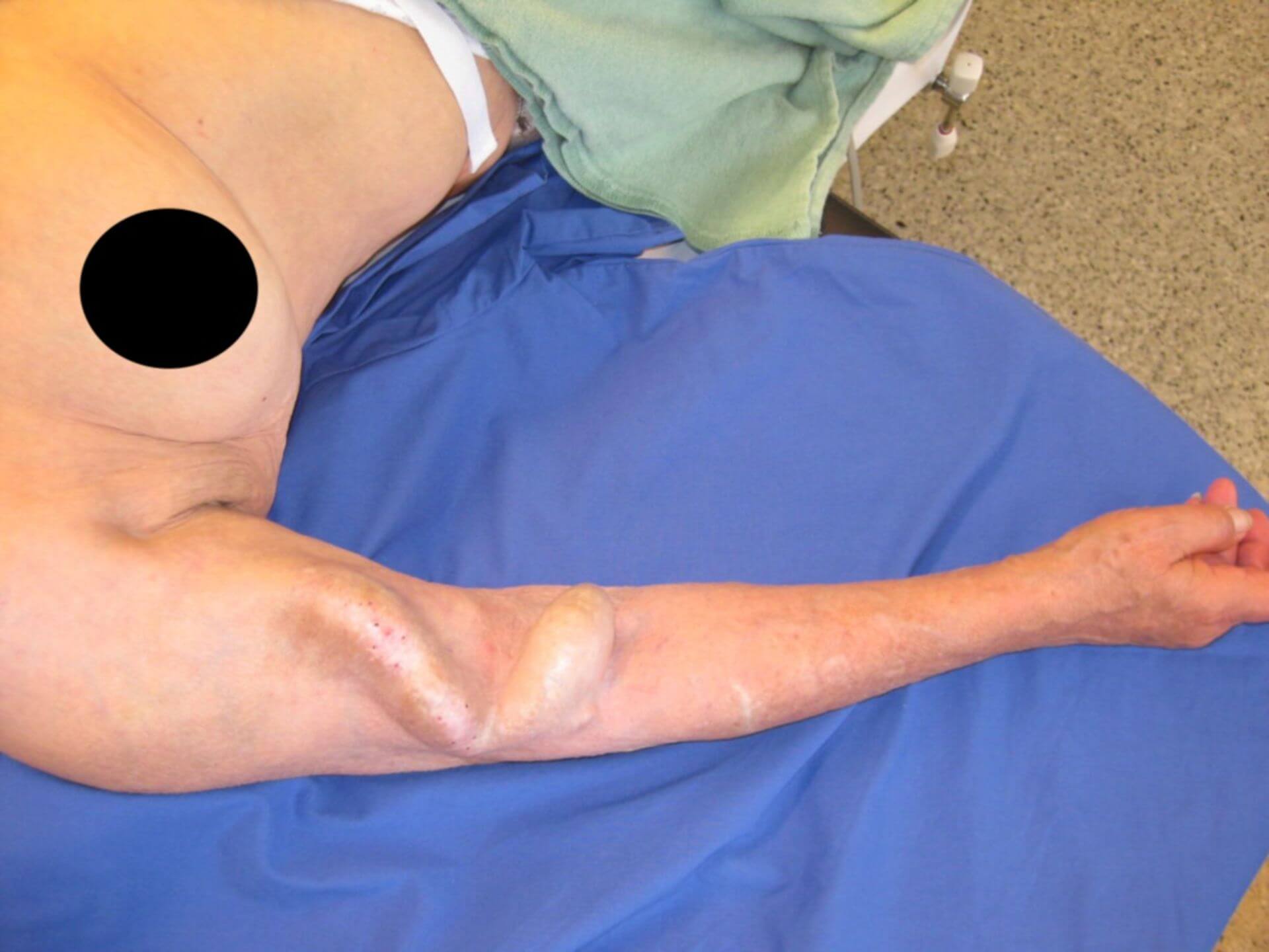 Dialyseshunt