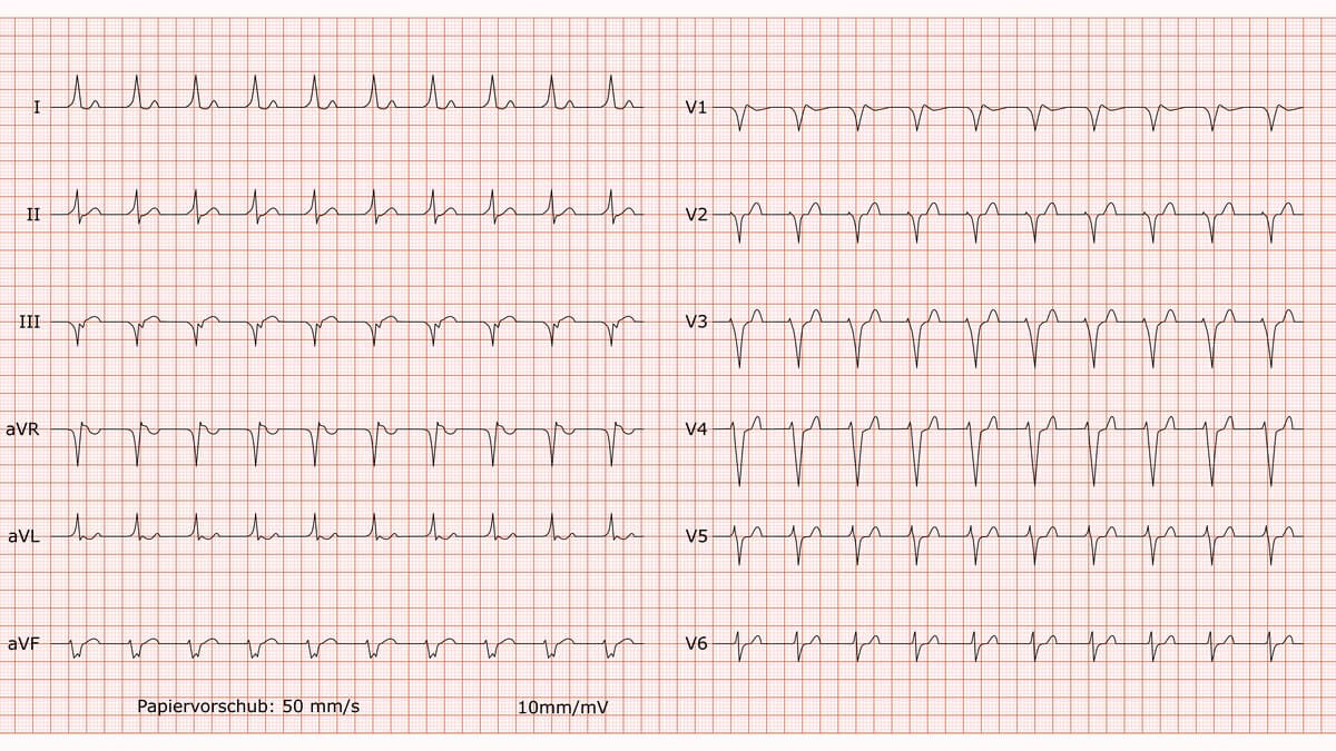 12-Kanal-EKG bei AV-Knoten-Reentrytachykardie