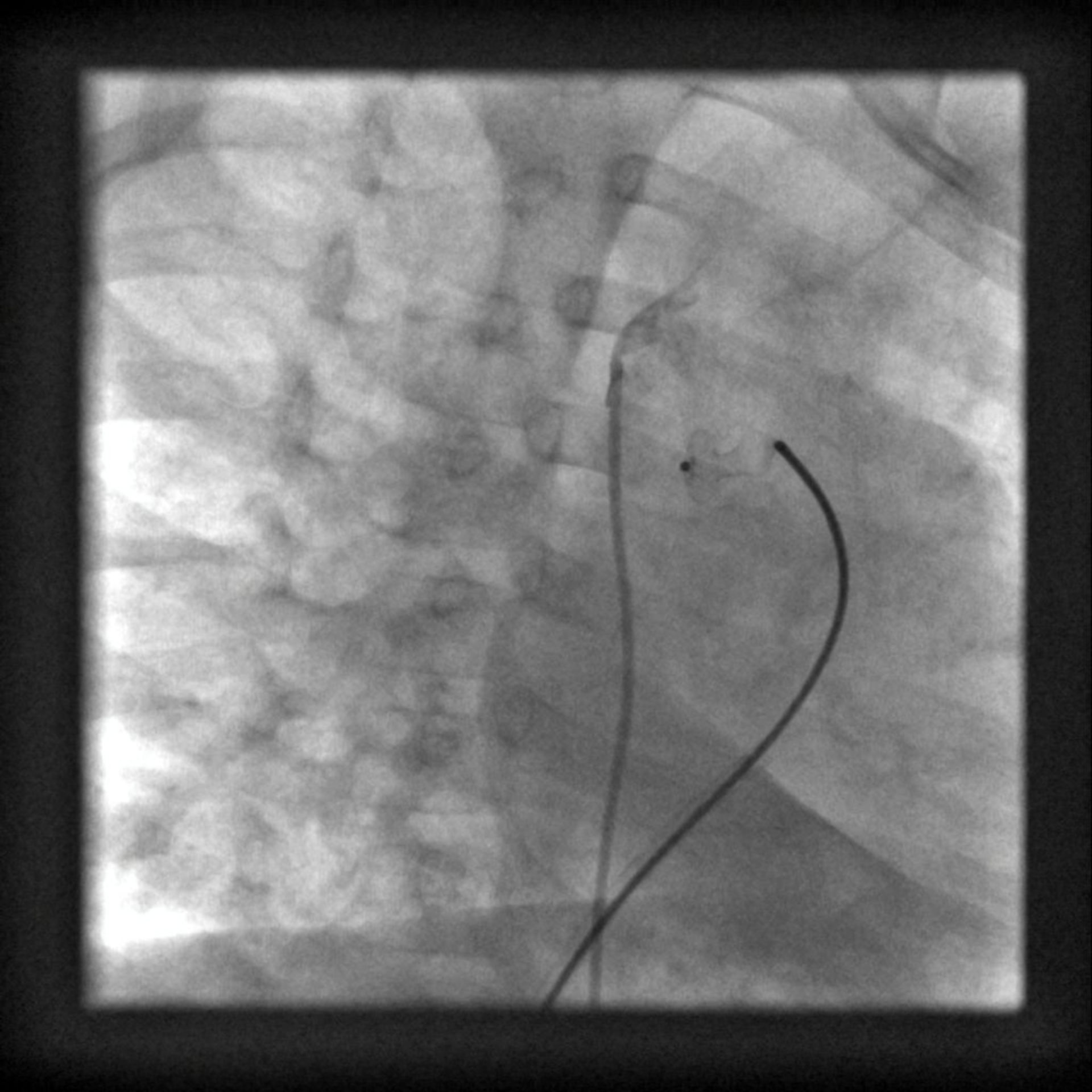 Angiography of the coronary arteries