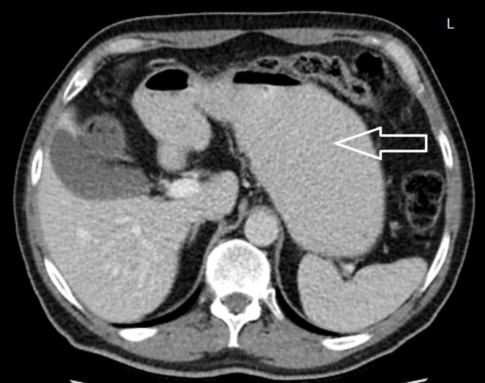 tra3: CT des Abdomens in transversaler Ebene