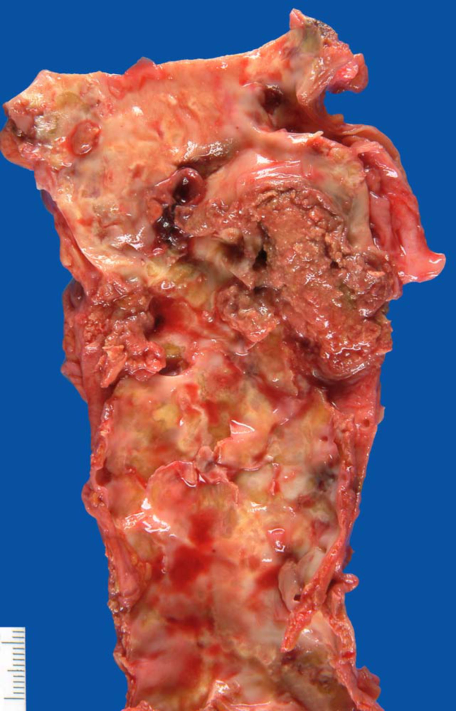 Atherosclerosis with ulcerated plaque