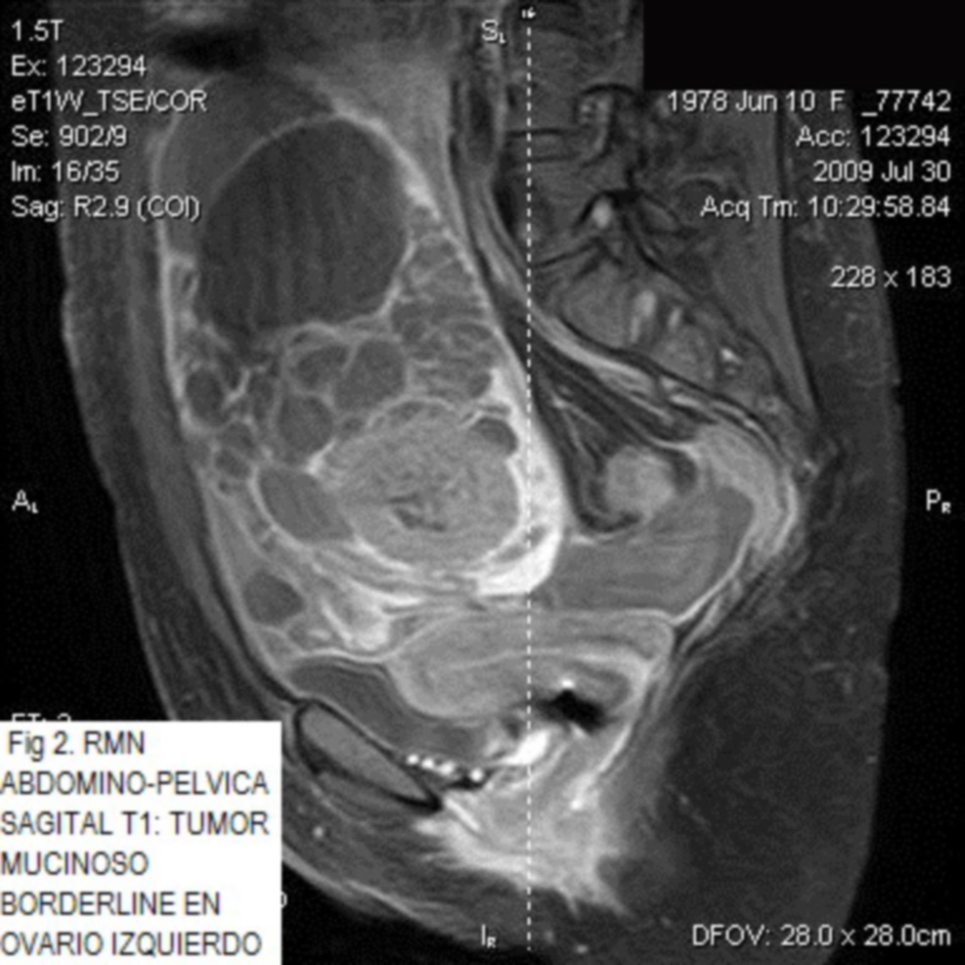 Borderline mucous carcinoma of the ovary with metastatic recurrence (Spanish description)