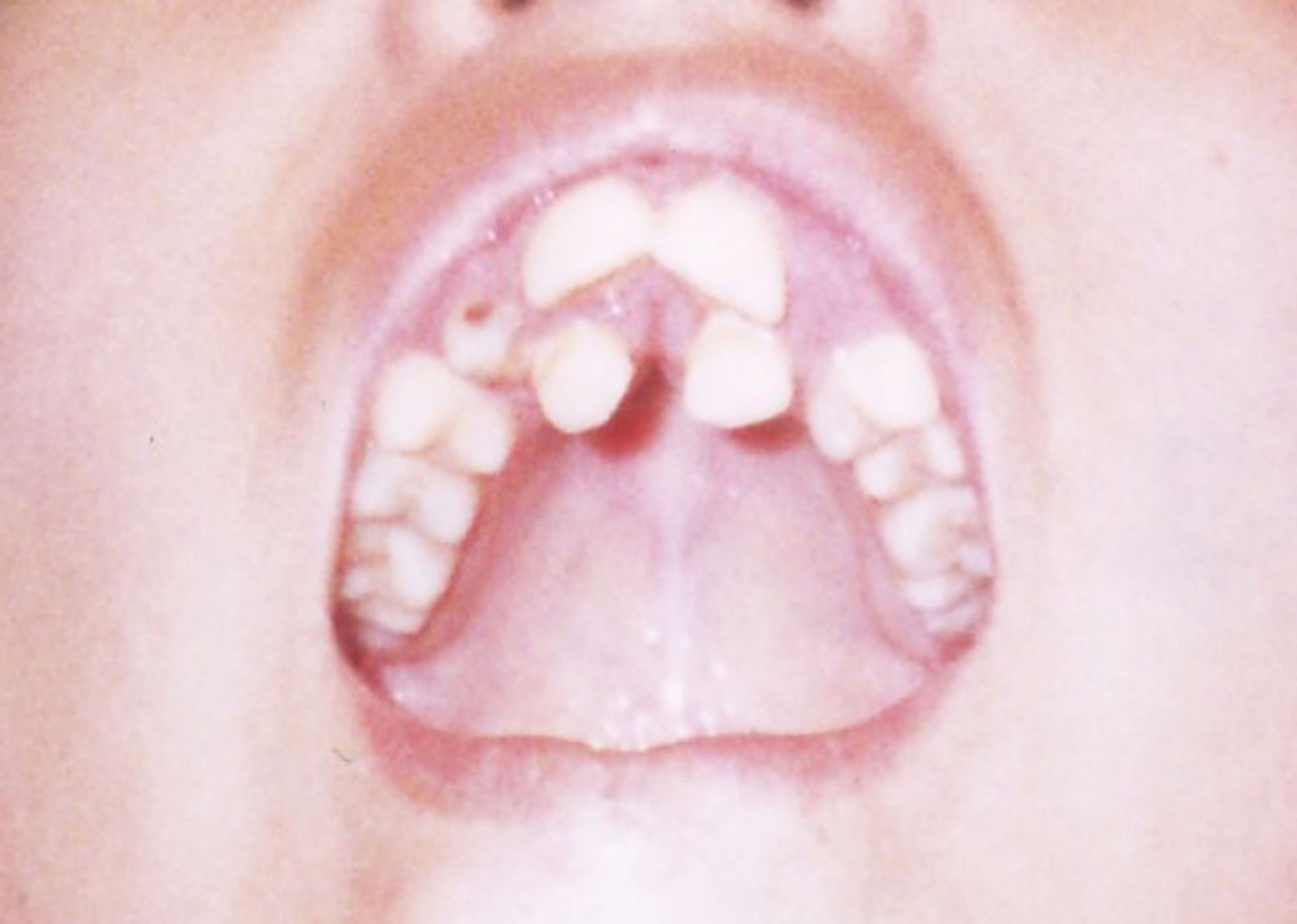 deformed teeth