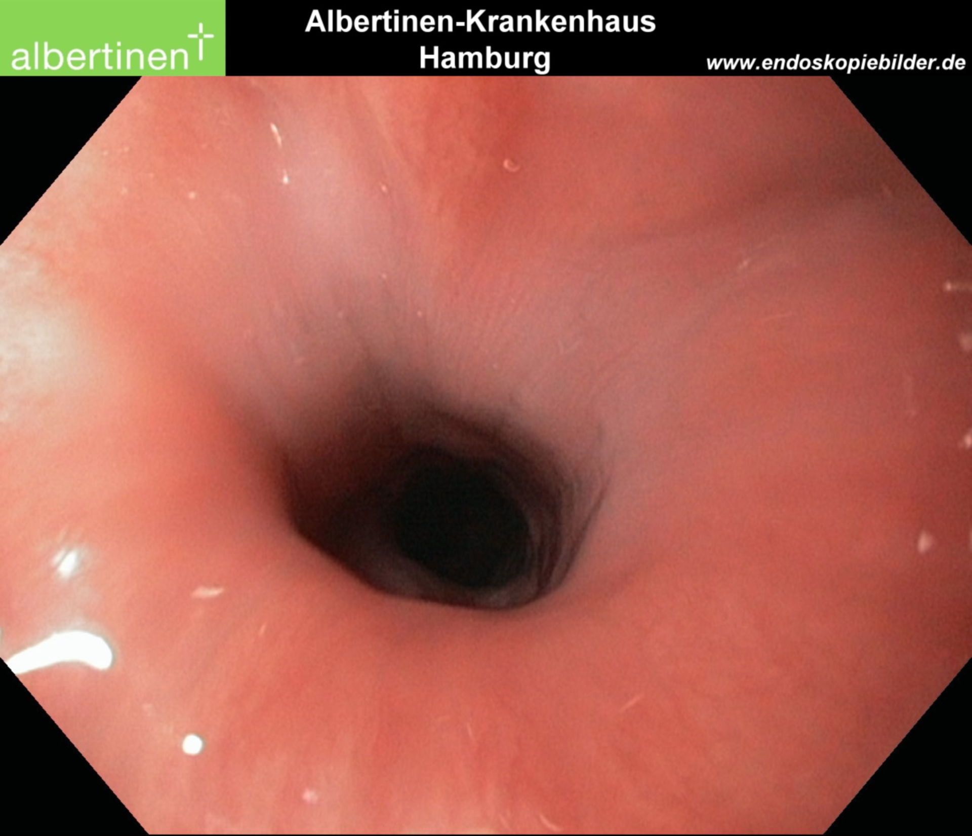 Sfintere esofageo superiore normale, endoscopia