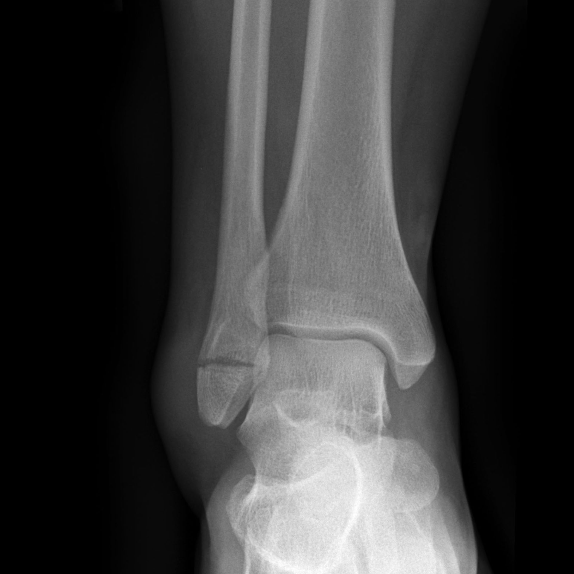 Трещина в суставе. Перелом лодыжки рентген. Рентген лодыжка передом. Перелом наружной лодыжки рентген. Перелом медиальной лодыжки большеберцовой кости.