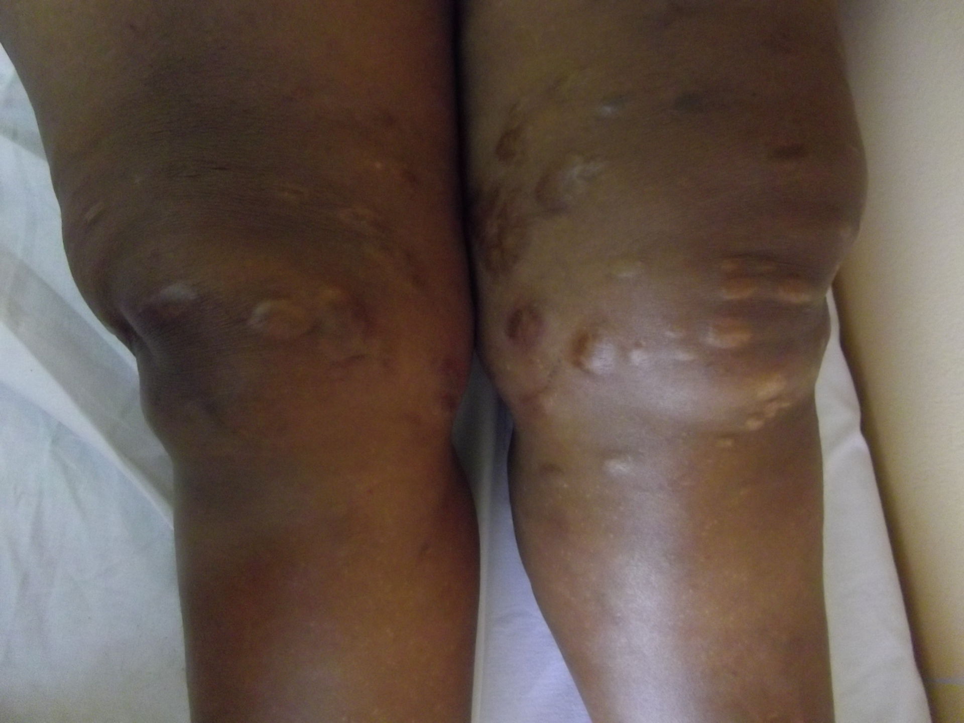Cicatrici cheloidi dopo scarificazione