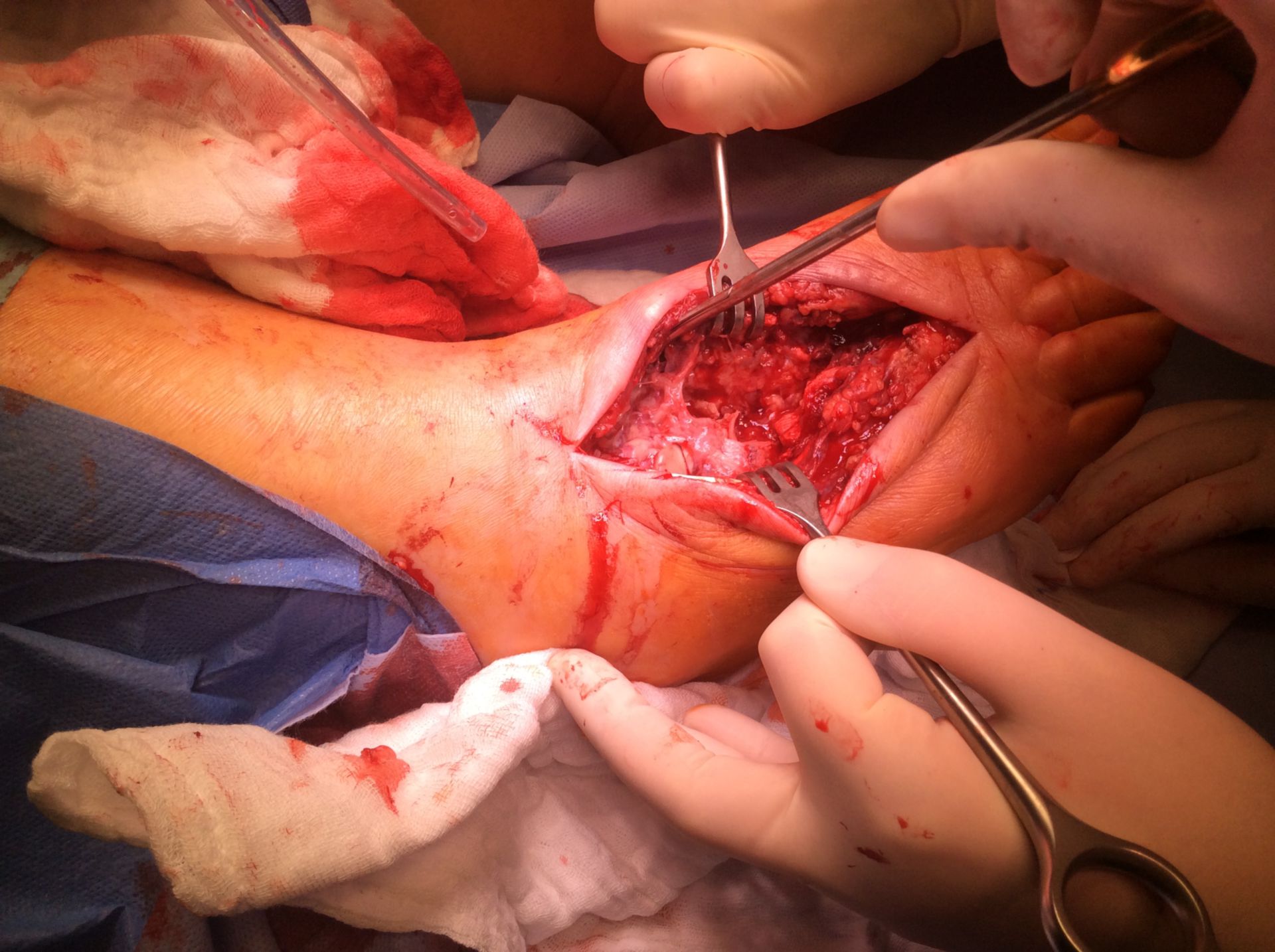 Operation of foot phlegmon