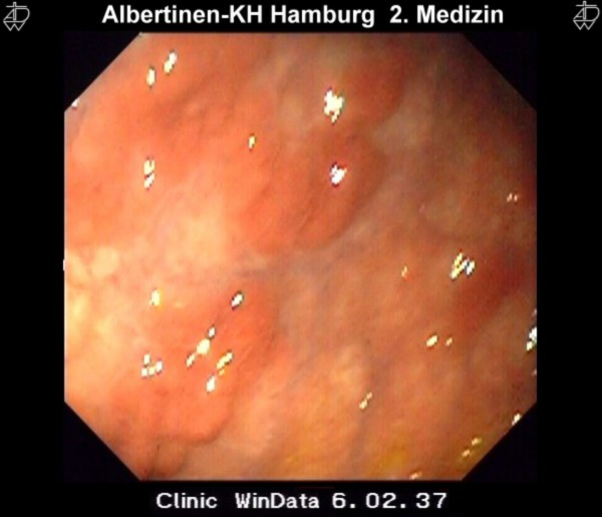 Atrophy of the gastric mucosa