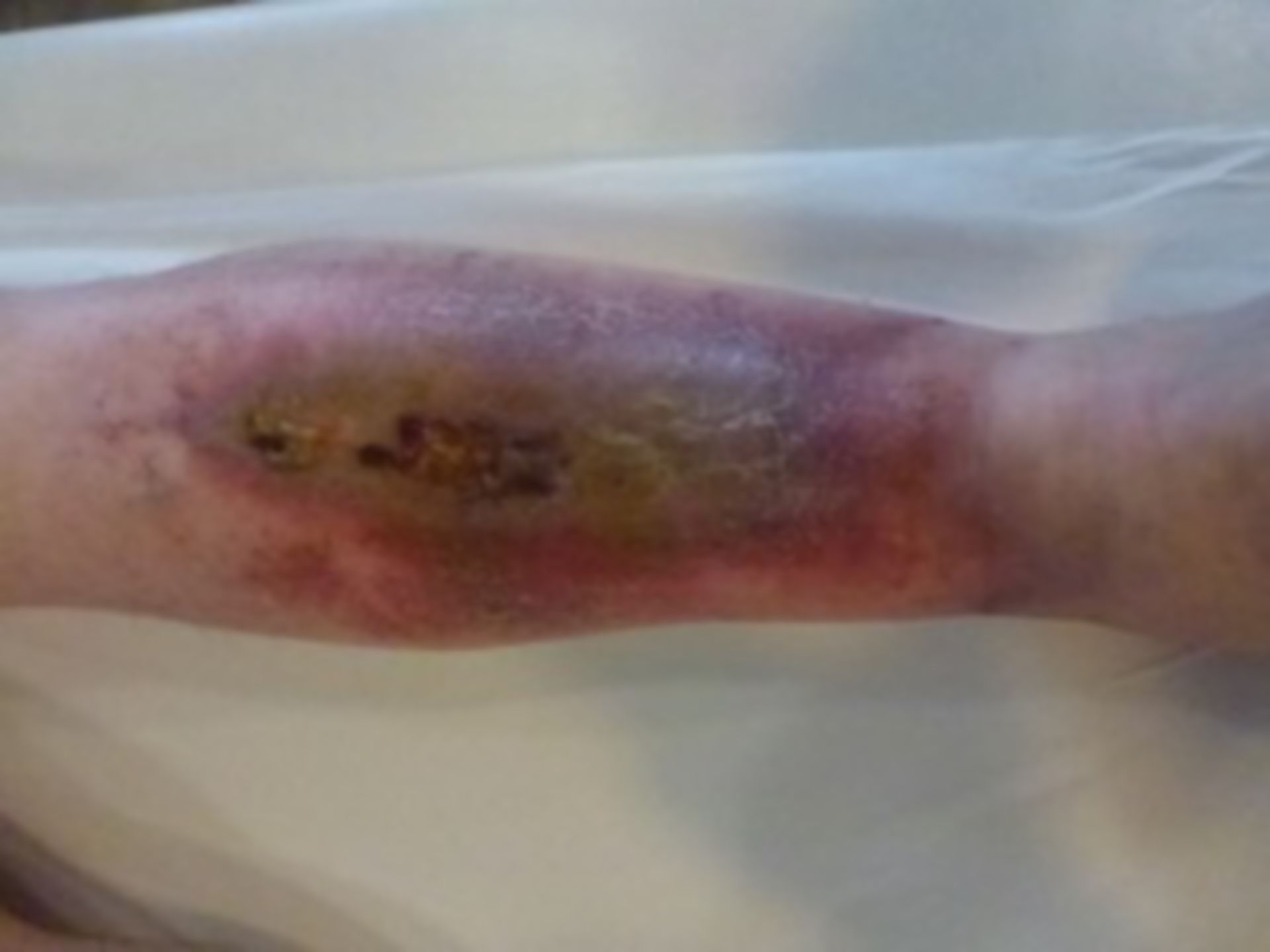 Úlcera de la pierna - abierta por 20 años: úlcera de app. 12cm x 3 cm (5)