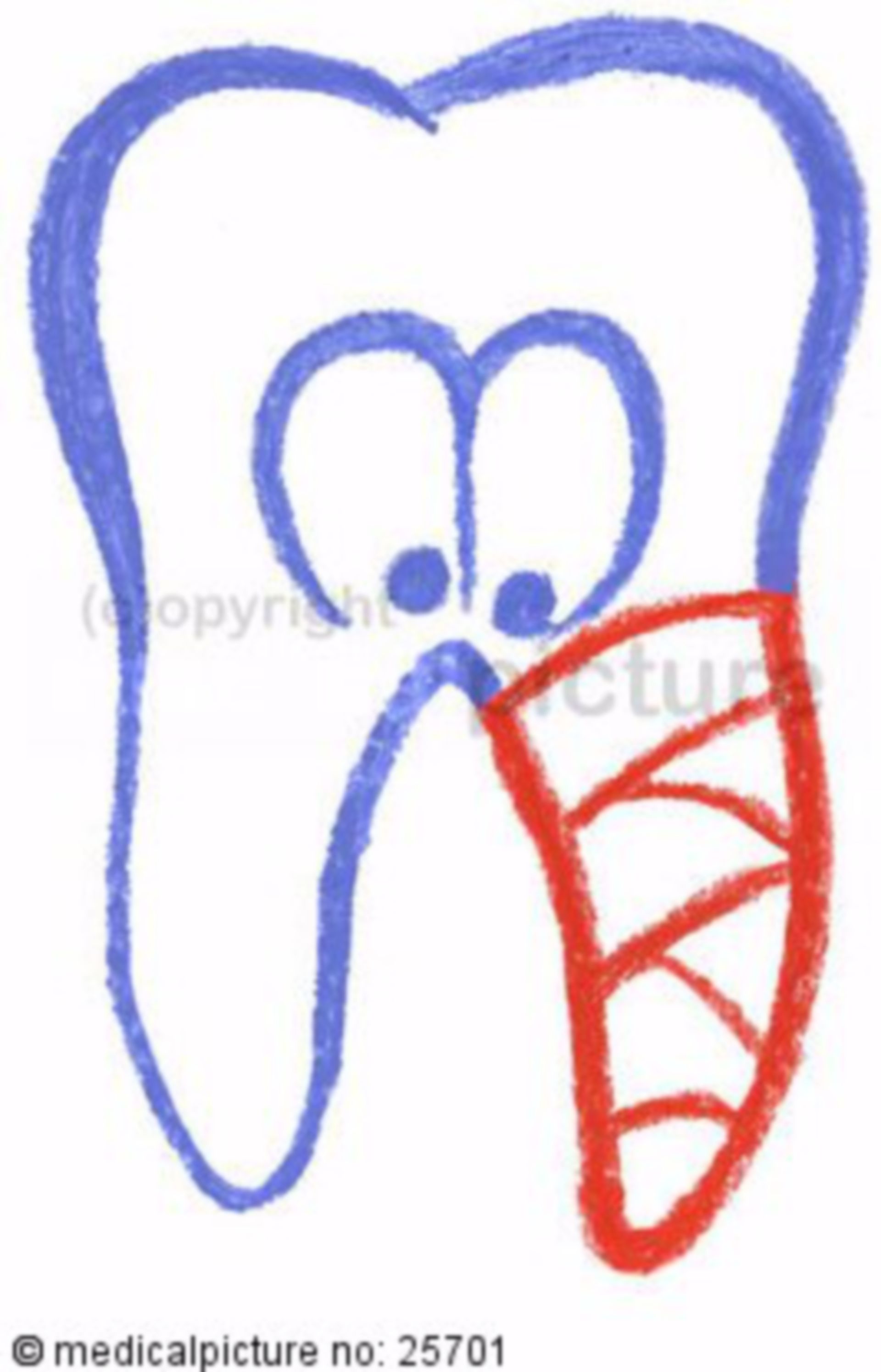  Zahn mit kranker Zahnwurzel 
