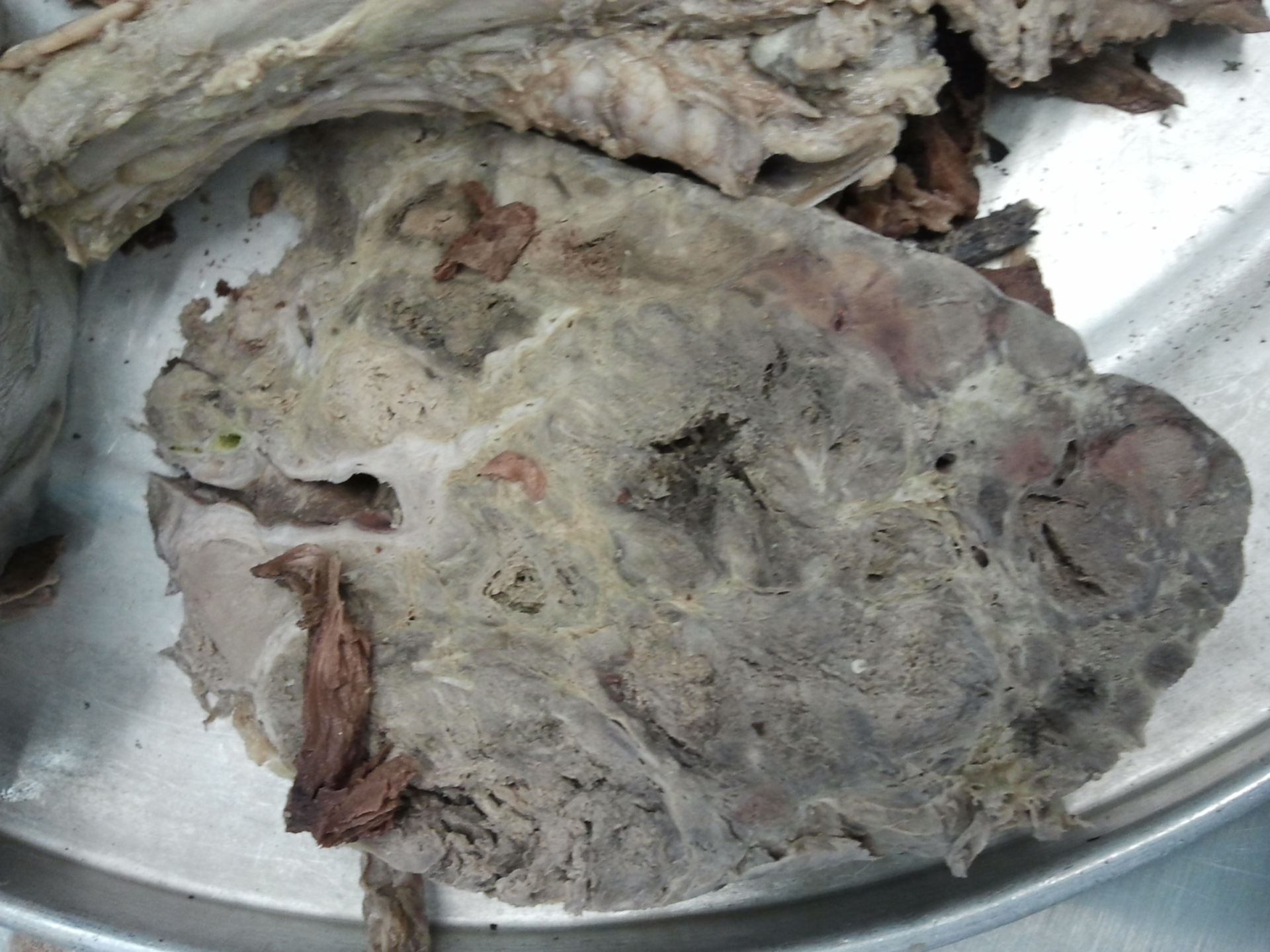 Liver with metastases