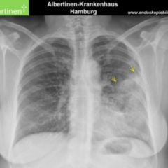 Invasives lobuläres Mammakarzinom DocCheck Flexikon