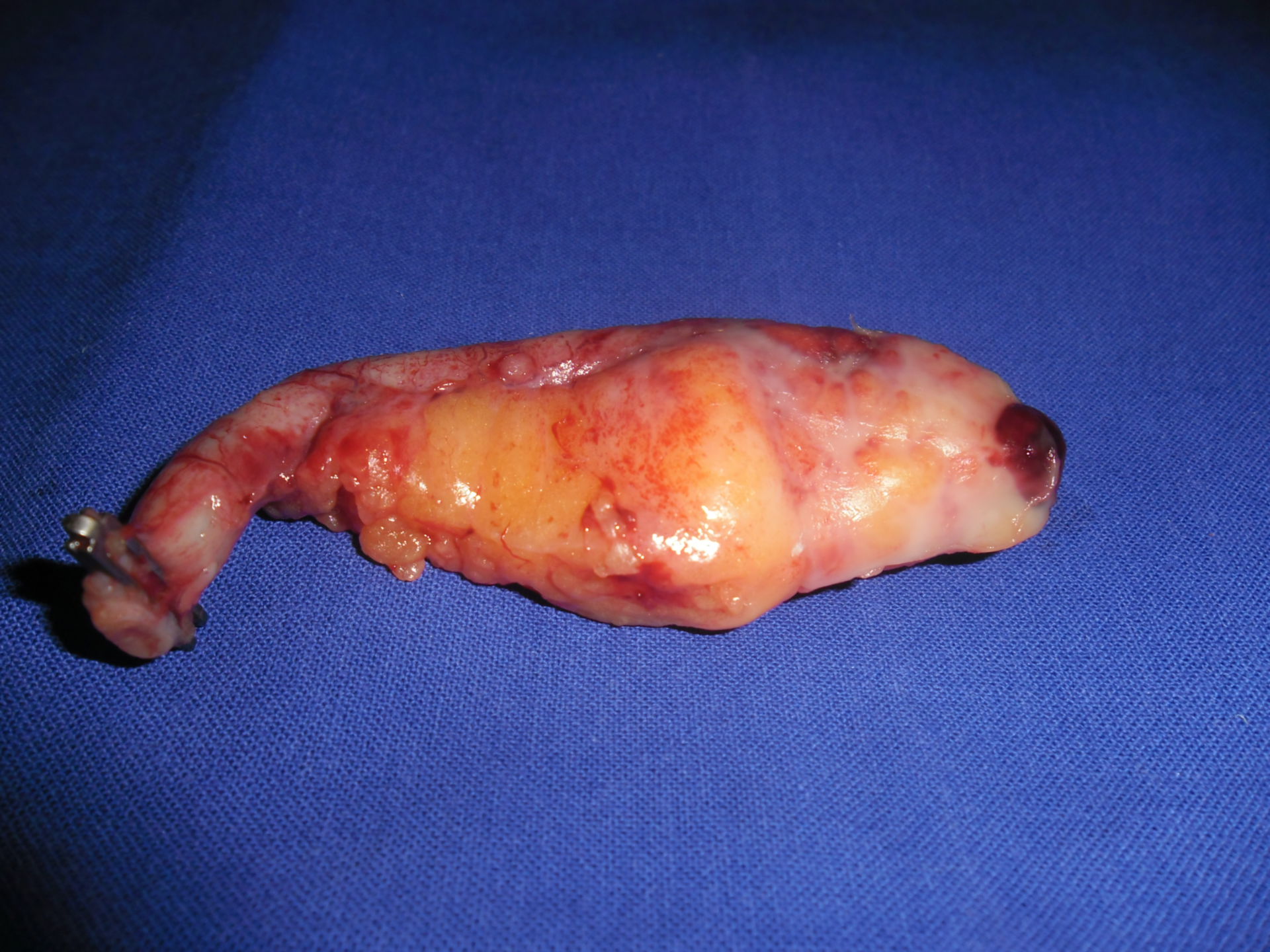 Perforated appendicitis