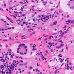 Xanthogranulom DocCheck Flexikon