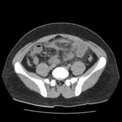 Backwash-Ileitis - DocCheck Flexikon