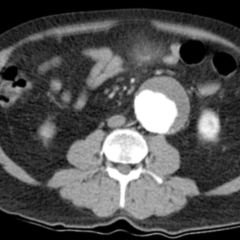 Thorakales Aortenaneurysma Doccheck Flexikon