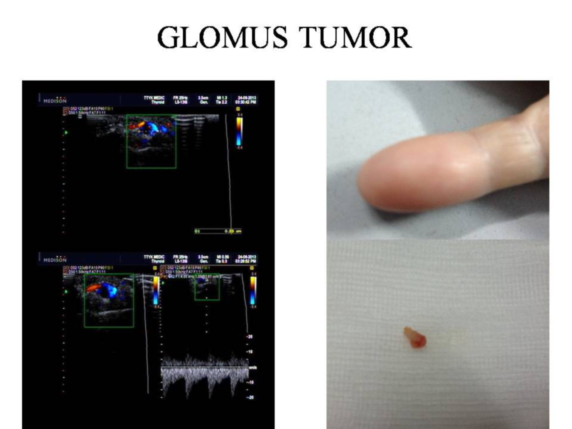 GLOMUS TUMOR